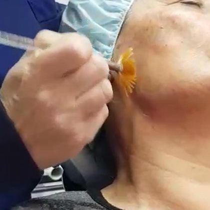 PEELING